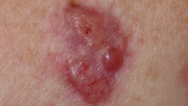basal cell carcinoma